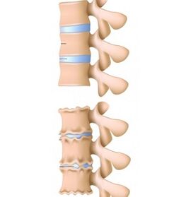 healthy spine and vertebrae are affected by osteochondrosis