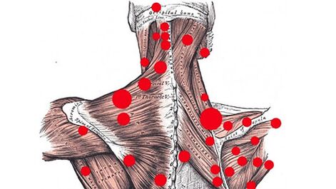 Trigger points on muscles that provoke myofascial back pain
