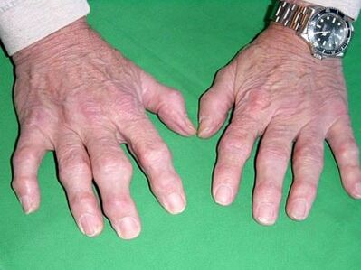 finger arthrosis