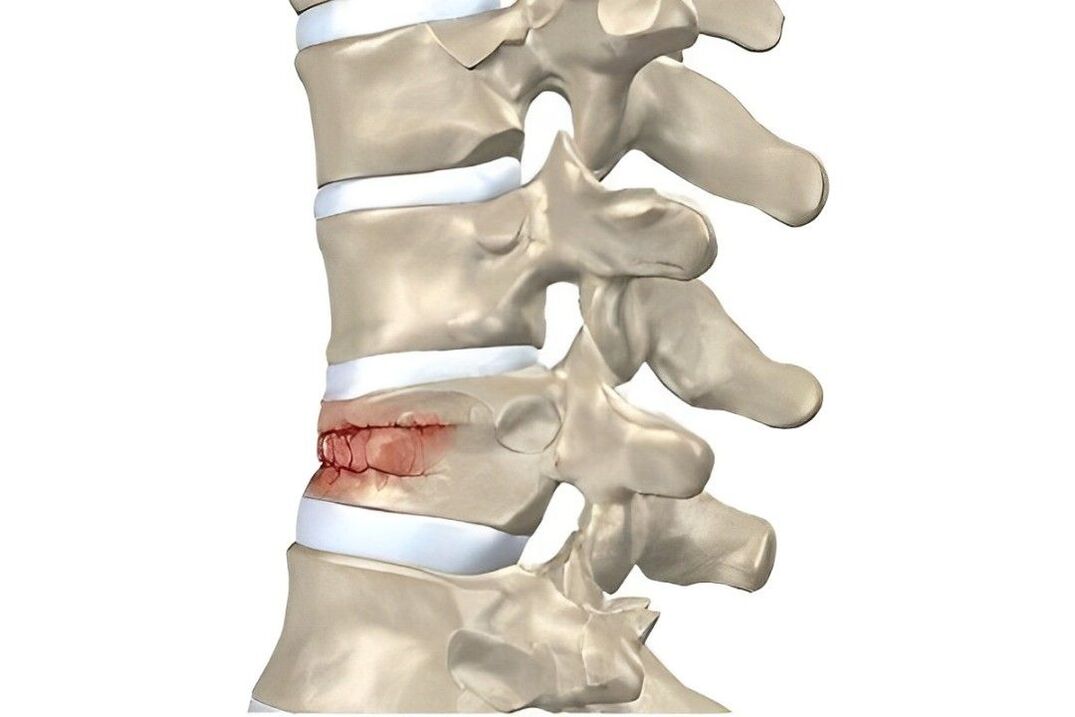 degree of spinal cord damage