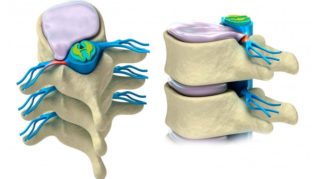 spinal disc is damaged