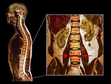 A degenerative disc in the spine