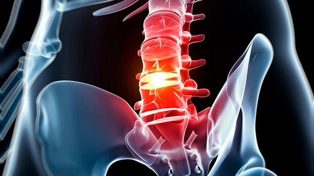 lumbar spinal osteochondrosis