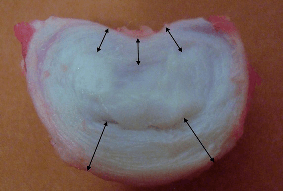 What does an intervertebral disc look like