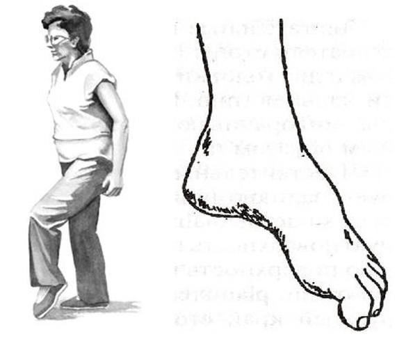 steppage or penis gait for osteochondrosis