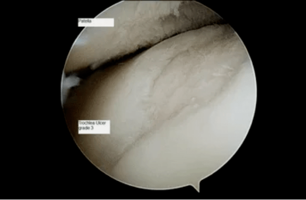 astroscopic view of the knee joint with 3rd degree arthrosis