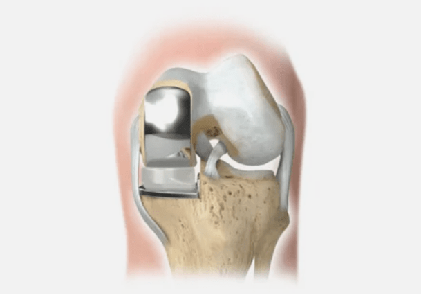 one part of the joint is damaged