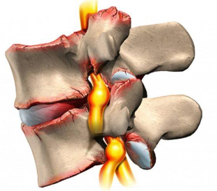 Osteocondrose of the vertebral column